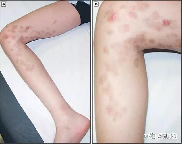 色素性紫癜性皮膚病 (pigmented purpuric dermatosis, ppd)是一組