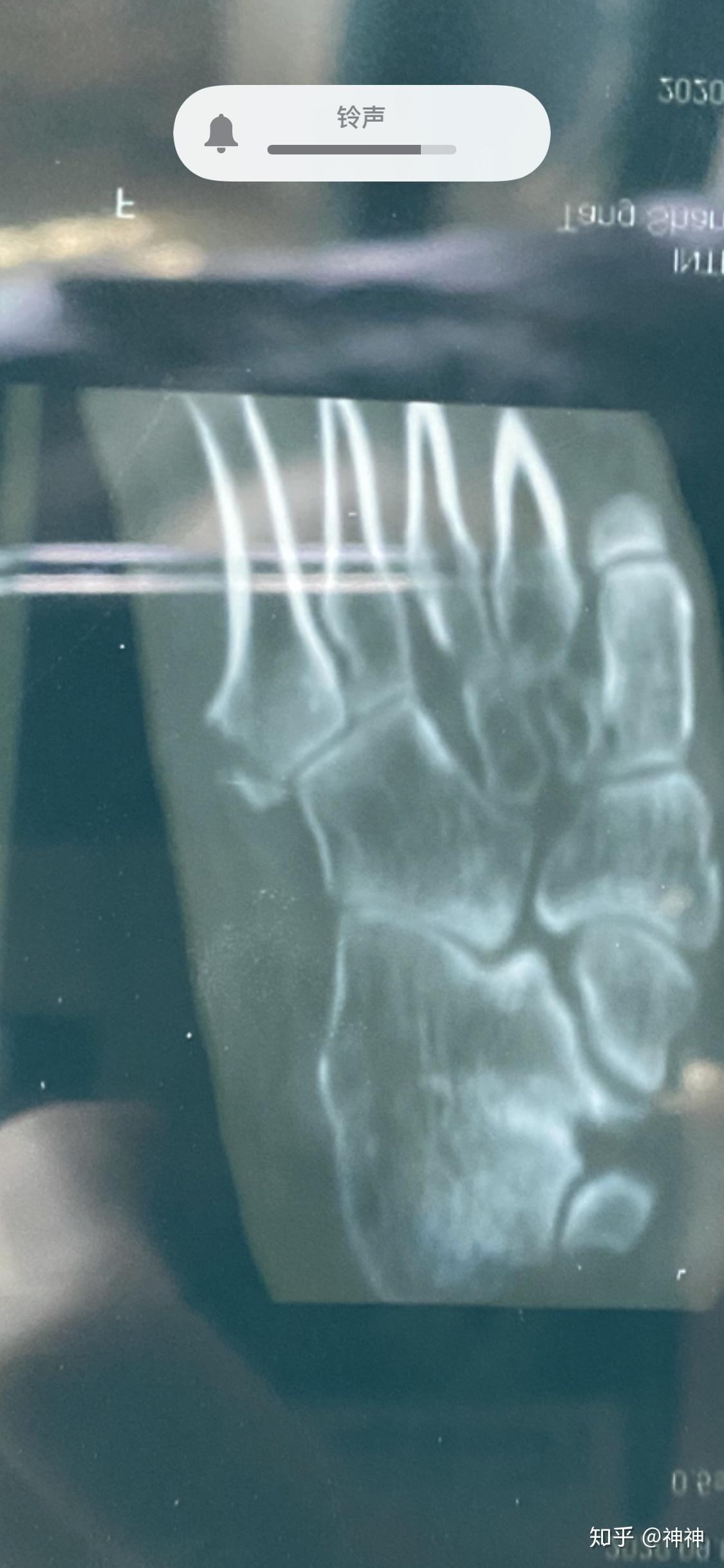 第五跖骨基底骨折缝隙有点大需要手术吗