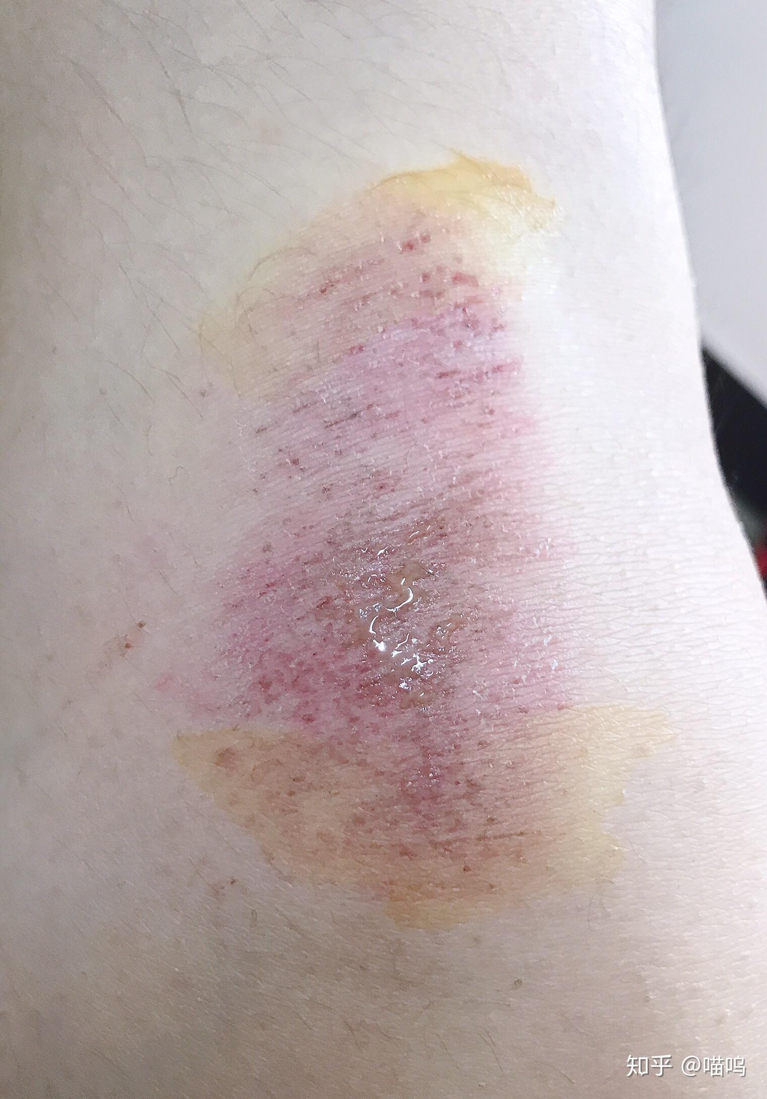 膝盖摔伤,抹了碘伏结痂后如何防止留疤? - 知乎