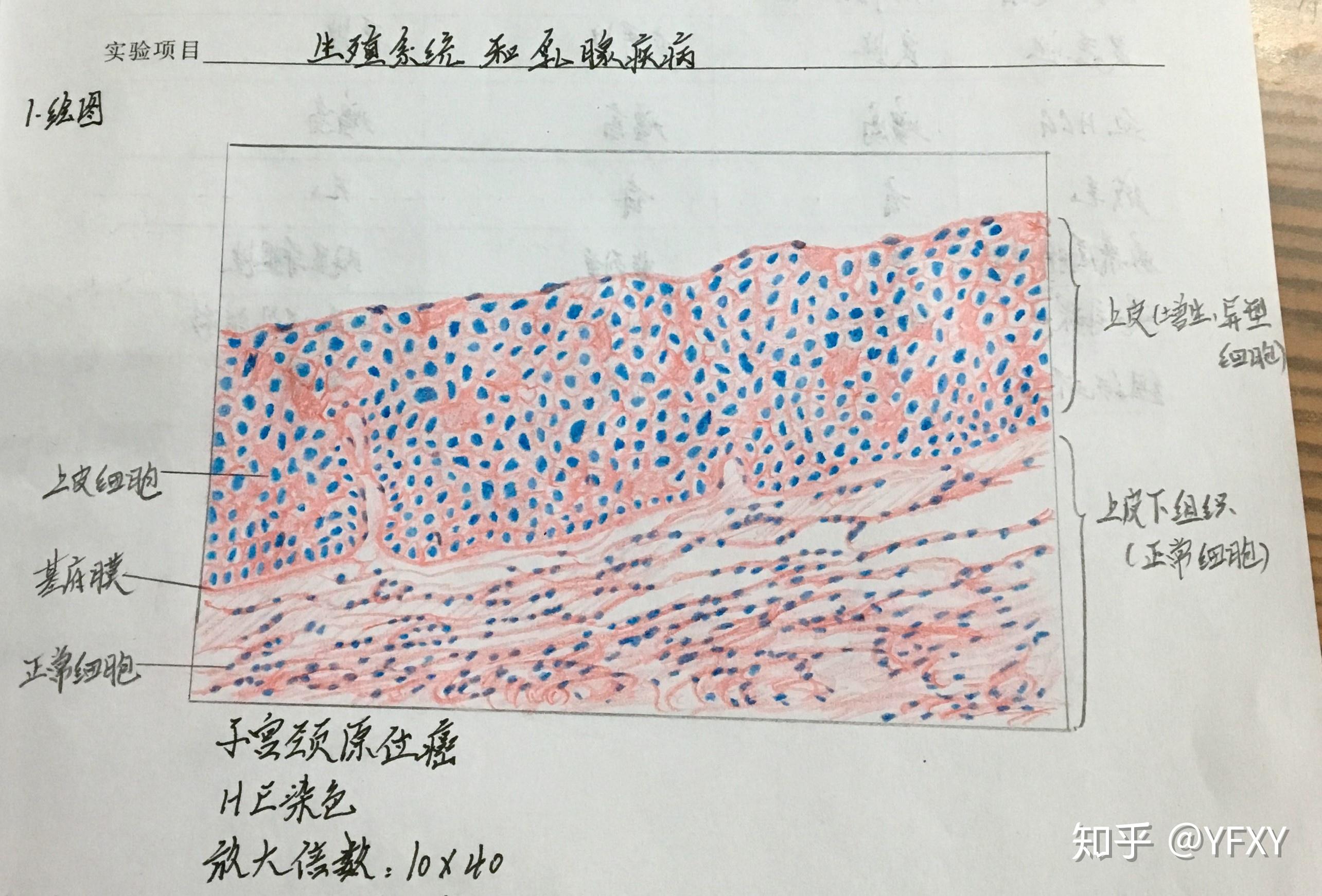 子宫平滑肌瘤红蓝绘图图片