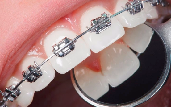 2.自锁托槽矫正