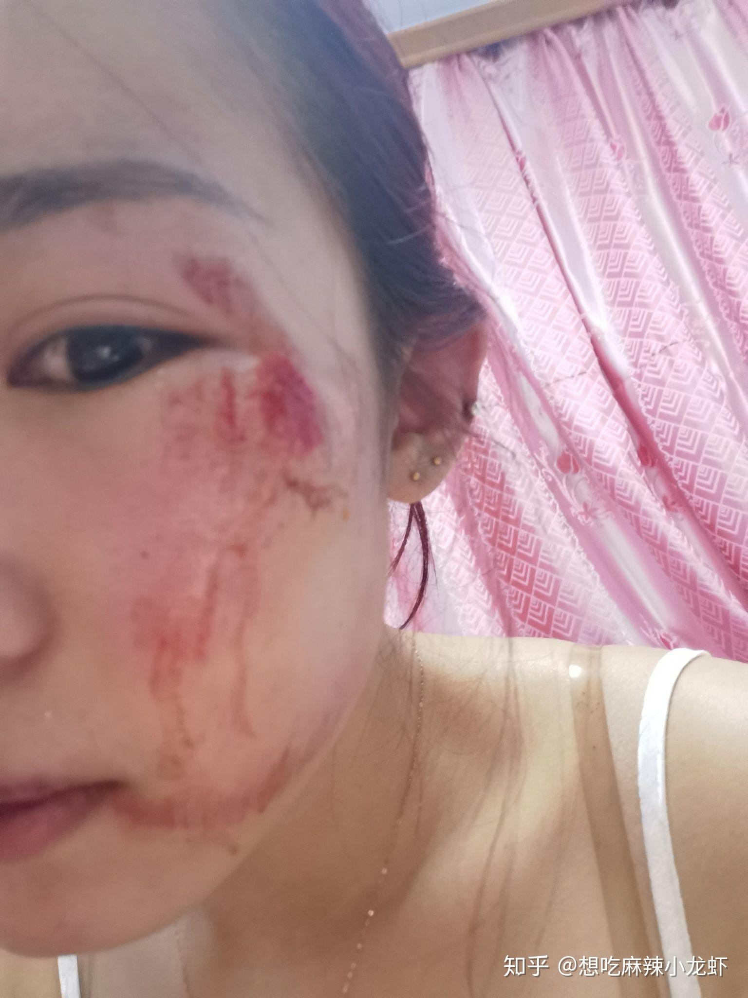 脸摔破了怎么才能不留疤? - 知乎