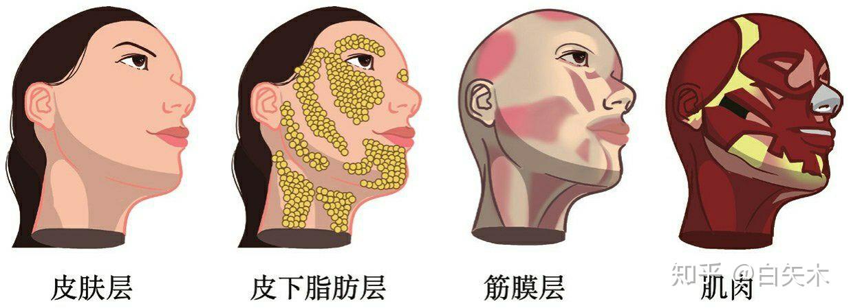 人体的面部从外到内依次是皮肤层,皮下脂肪层,筋膜层,肌肉,最后是骨骼