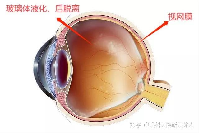 視網膜脫離到底是什麼