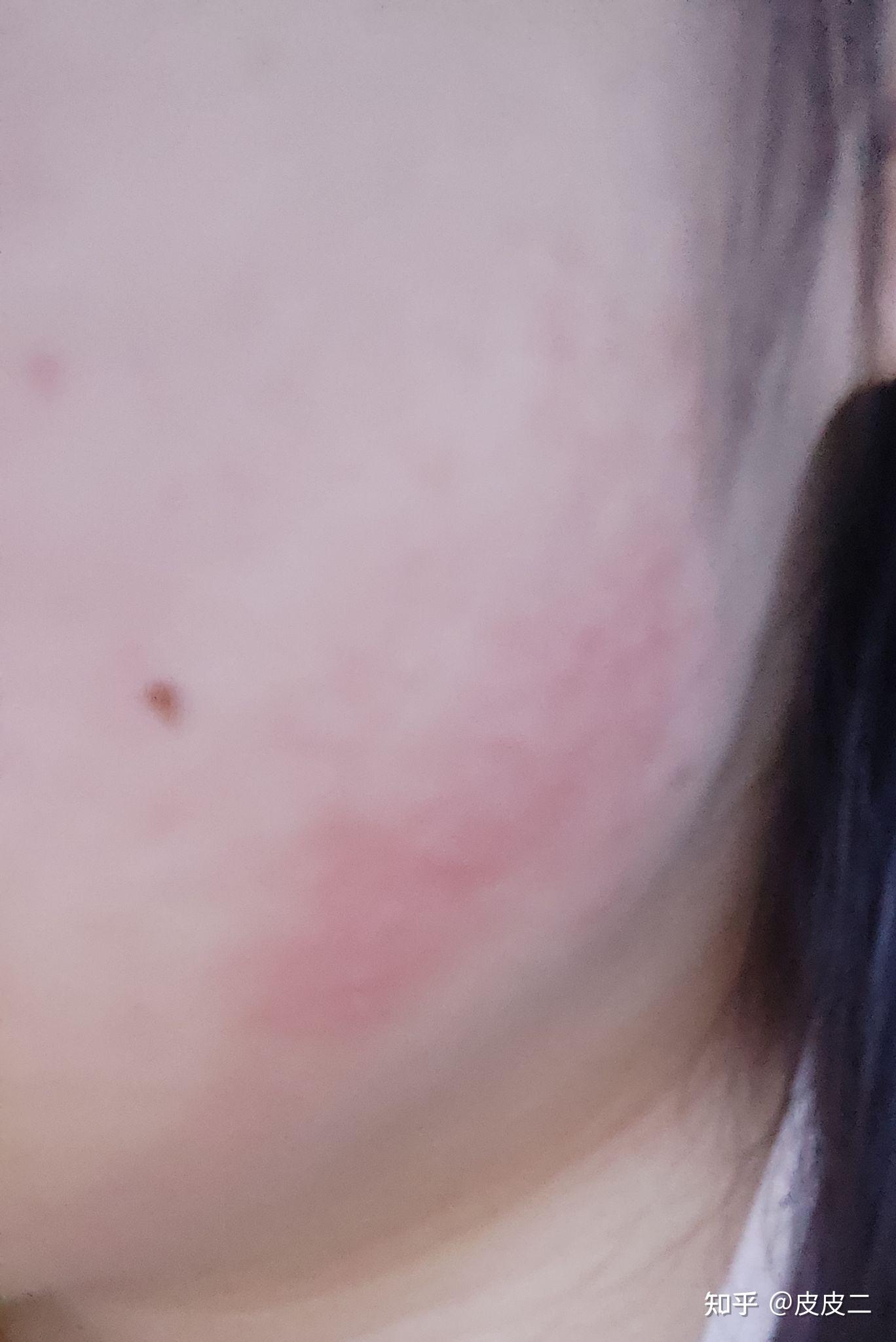 脸鸡皮疙瘩留下的疤怎么办(脸鸡皮疙瘩留下的疤怎么办图片)