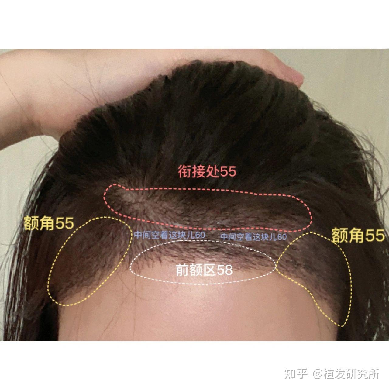 洗脸影响植发(植发后洗头会把毛囊洗掉吗)