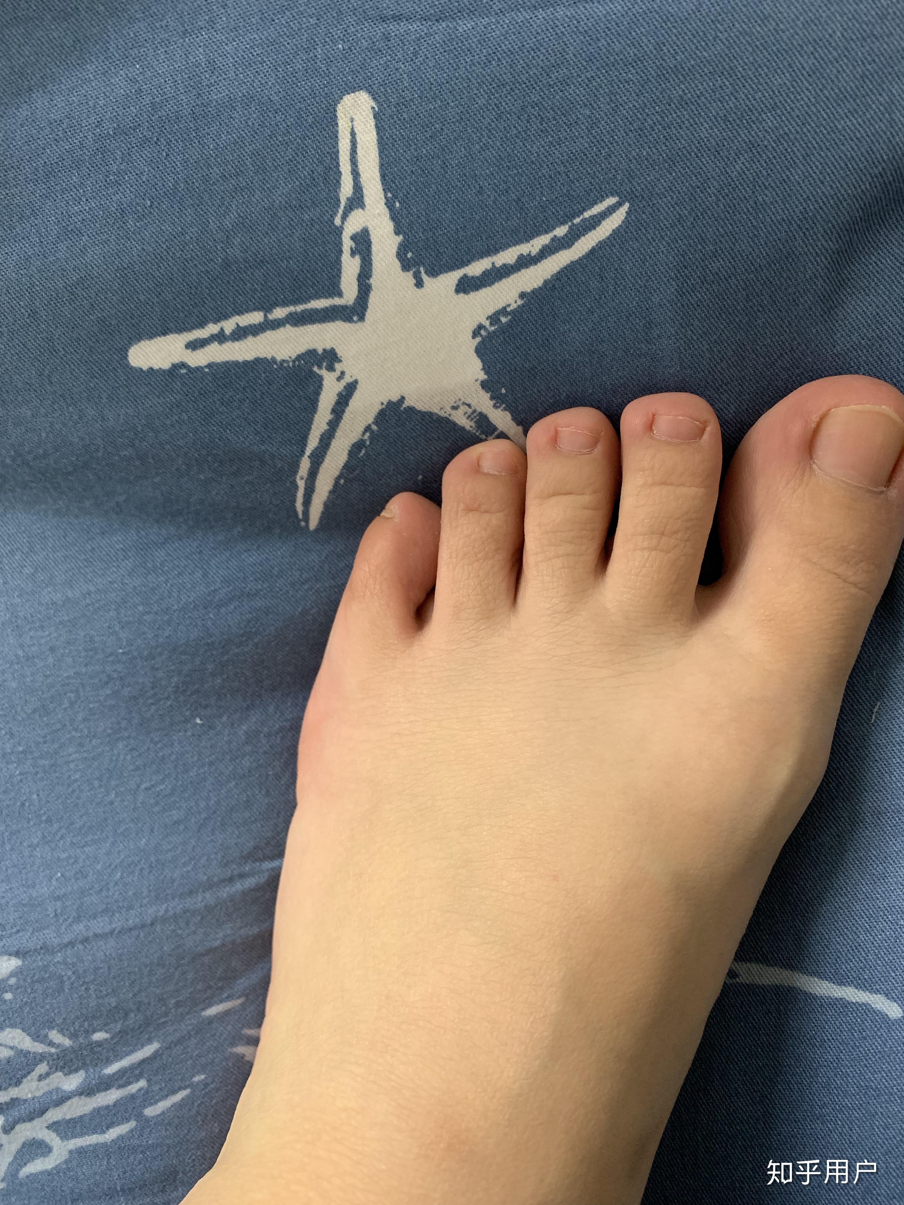 5岁小朋友脚很臭怎么办