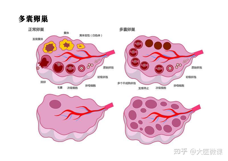 卵巢囊肿会自己消失的吗