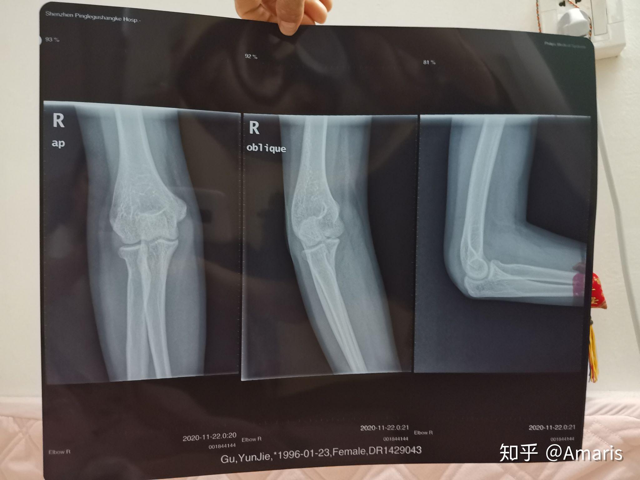 手肘摔伤不能伸直和抬高拍了片子说是可能骨折了但是