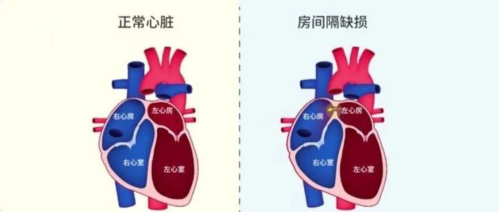 房间隔缺损的外科修补和介入封堵治疗 - 知乎