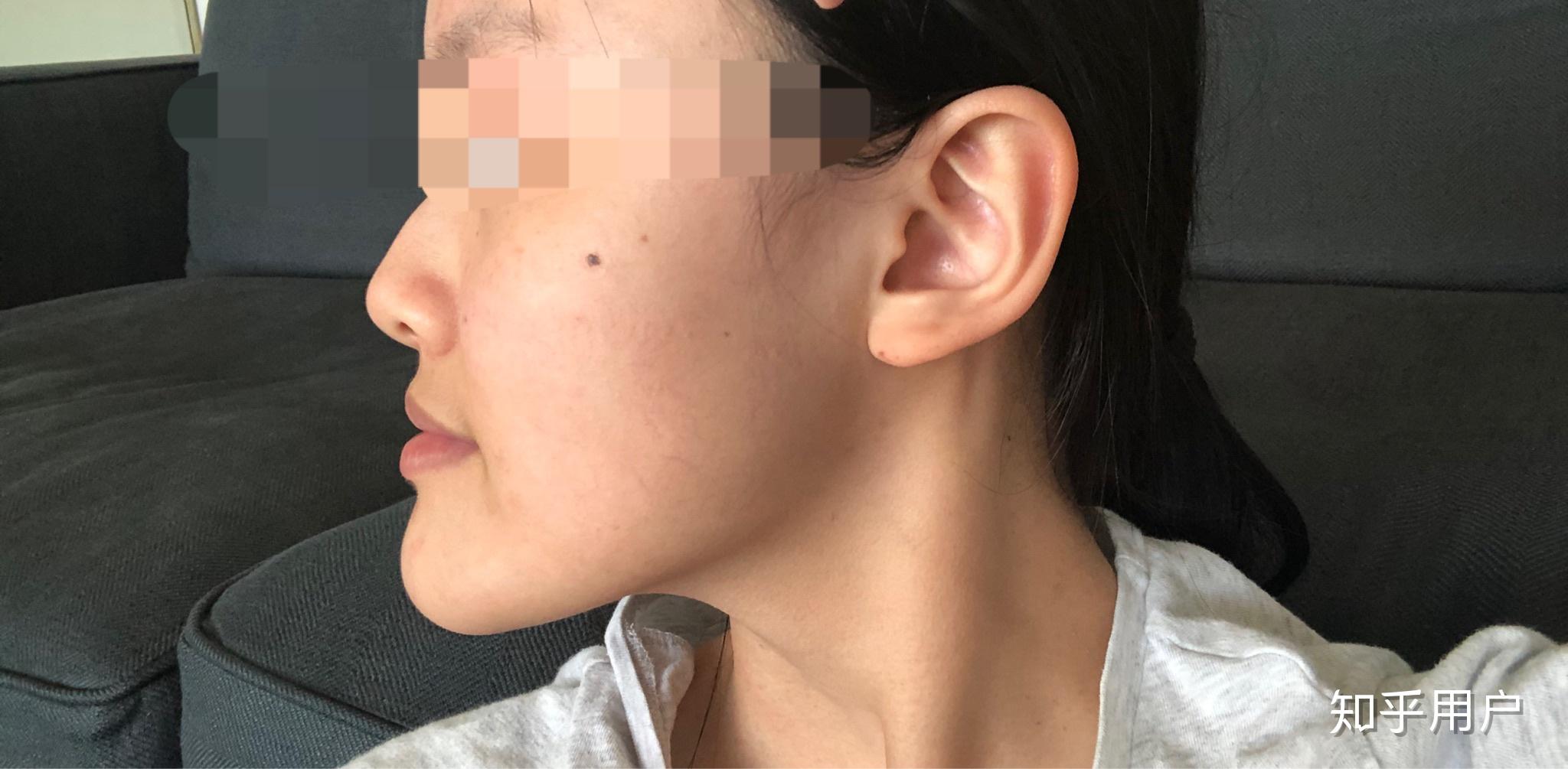 月亮脸,面中凹陷,下巴突出,很丑很自卑,请问正颌手术能改变我的脸型吗