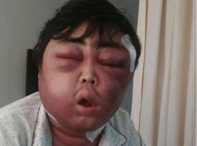 成人也是悲催了,某地一男子,被蚊子咬后变猪头脸了,实在太可气了;小