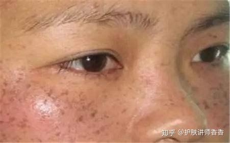 人脸常见4种斑点 如何不晒出斑点 掌握5大原则 避免恼人斑点 知乎