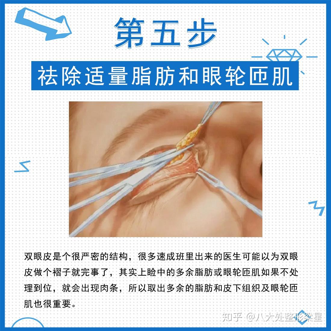 爱美者不了解全切双眼皮过程,只是因为没有看过切开双眼皮的过程图解