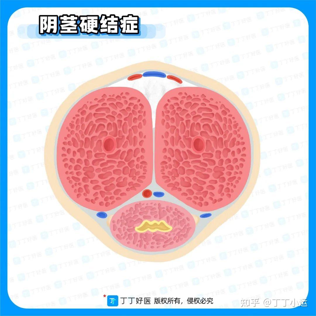 難以進行性生活,存在硬結鈣化;保守治療無效;>患者希望病情得到快速