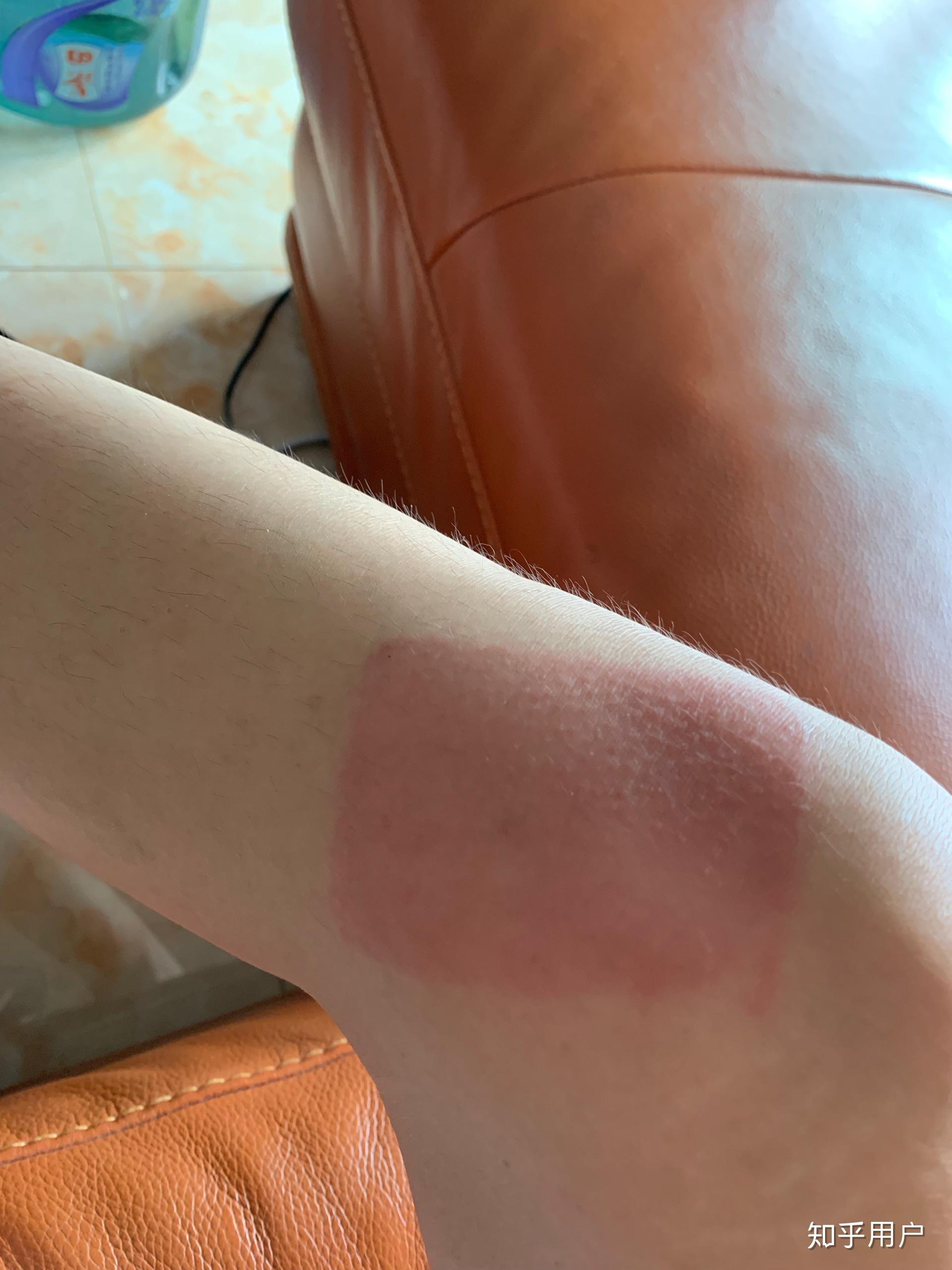 贴膏药过敏怎么办? - 知乎