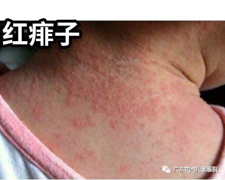 炎炎夏日,宝宝长痱子好捉急,能不能p掉啊!