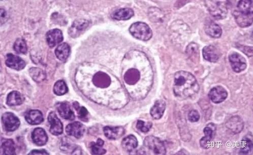 什么原因会引起淋巴肿瘤 v2-31dc0b1b9f02cb94fad80f73ad8330e0_r.jpg