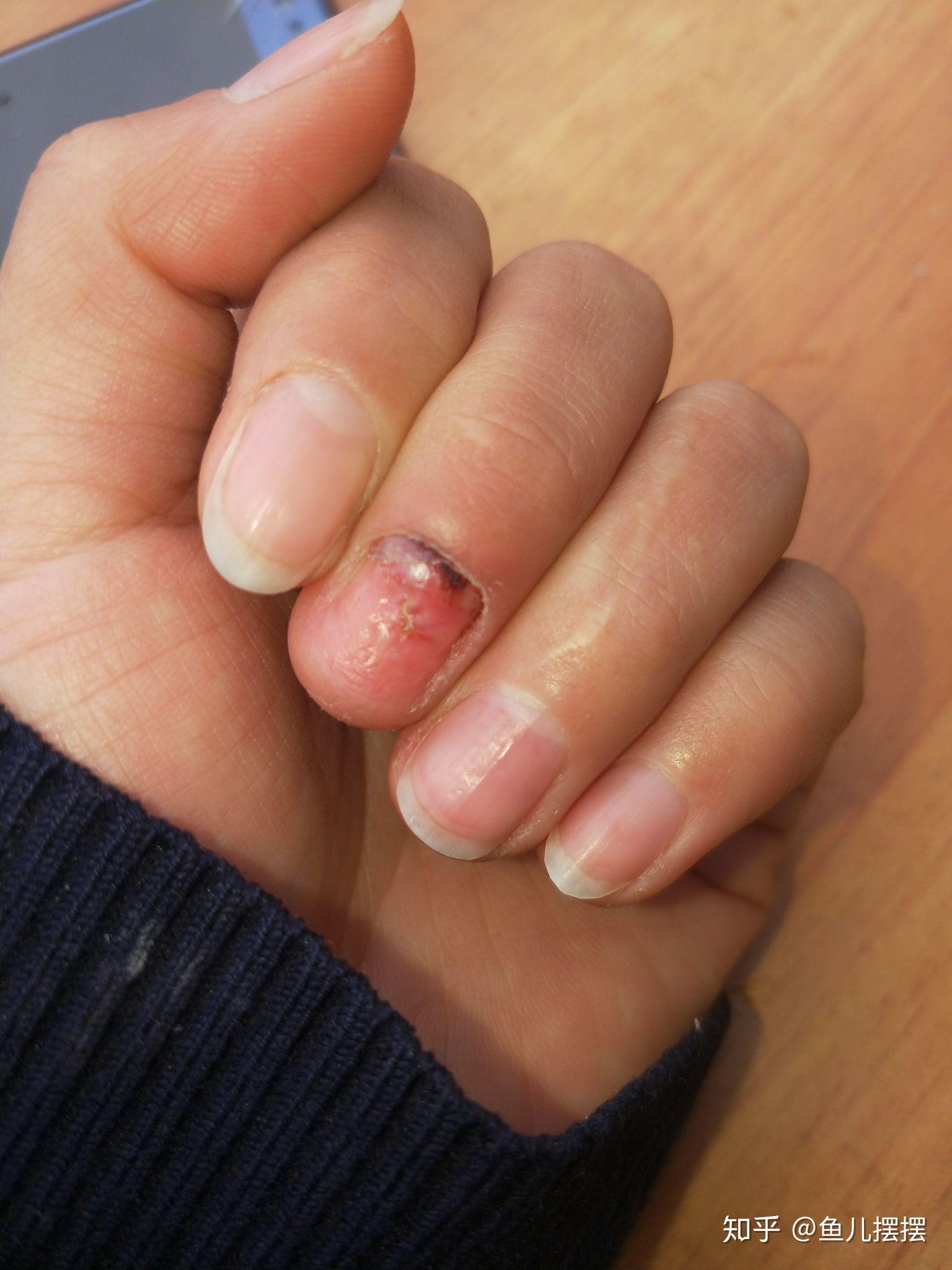 手指被门夹到飙泪是种怎样的体验