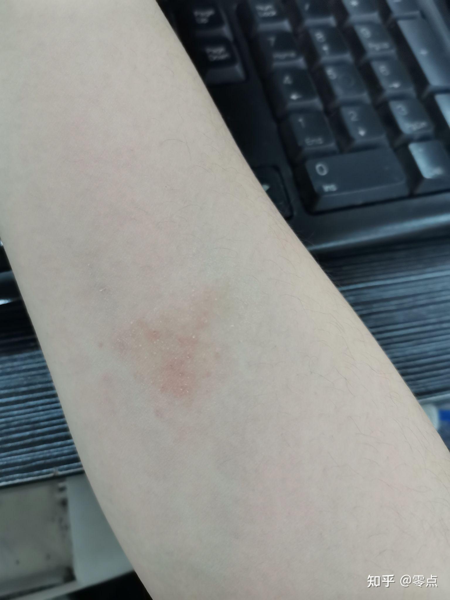 手臂上有一小块粗糙的皮肤偶尔痒像廯应该用什么药