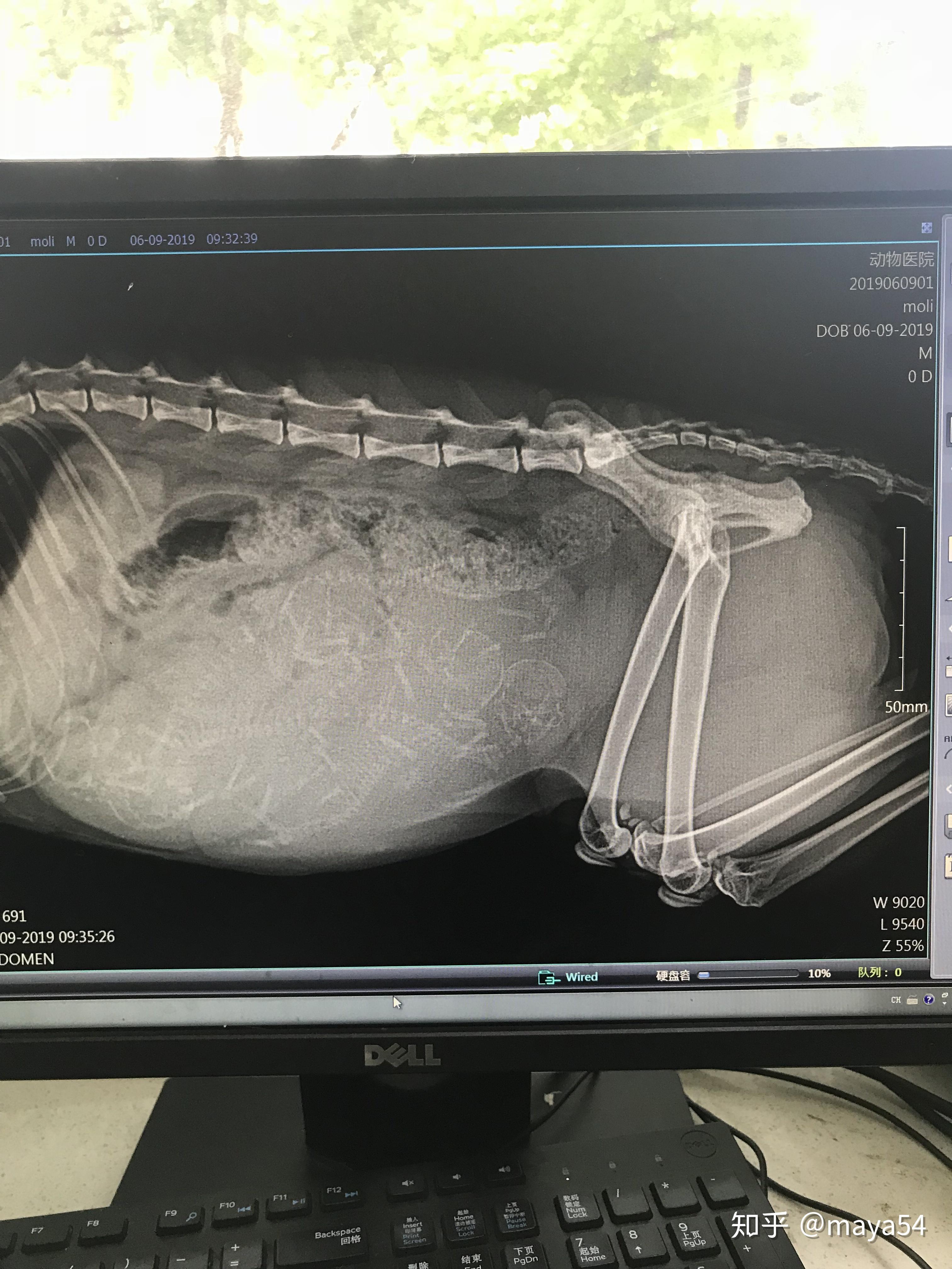 6月9日,我已经按奈不住去医院照了x光,可能还是太早看不太清,医生说三