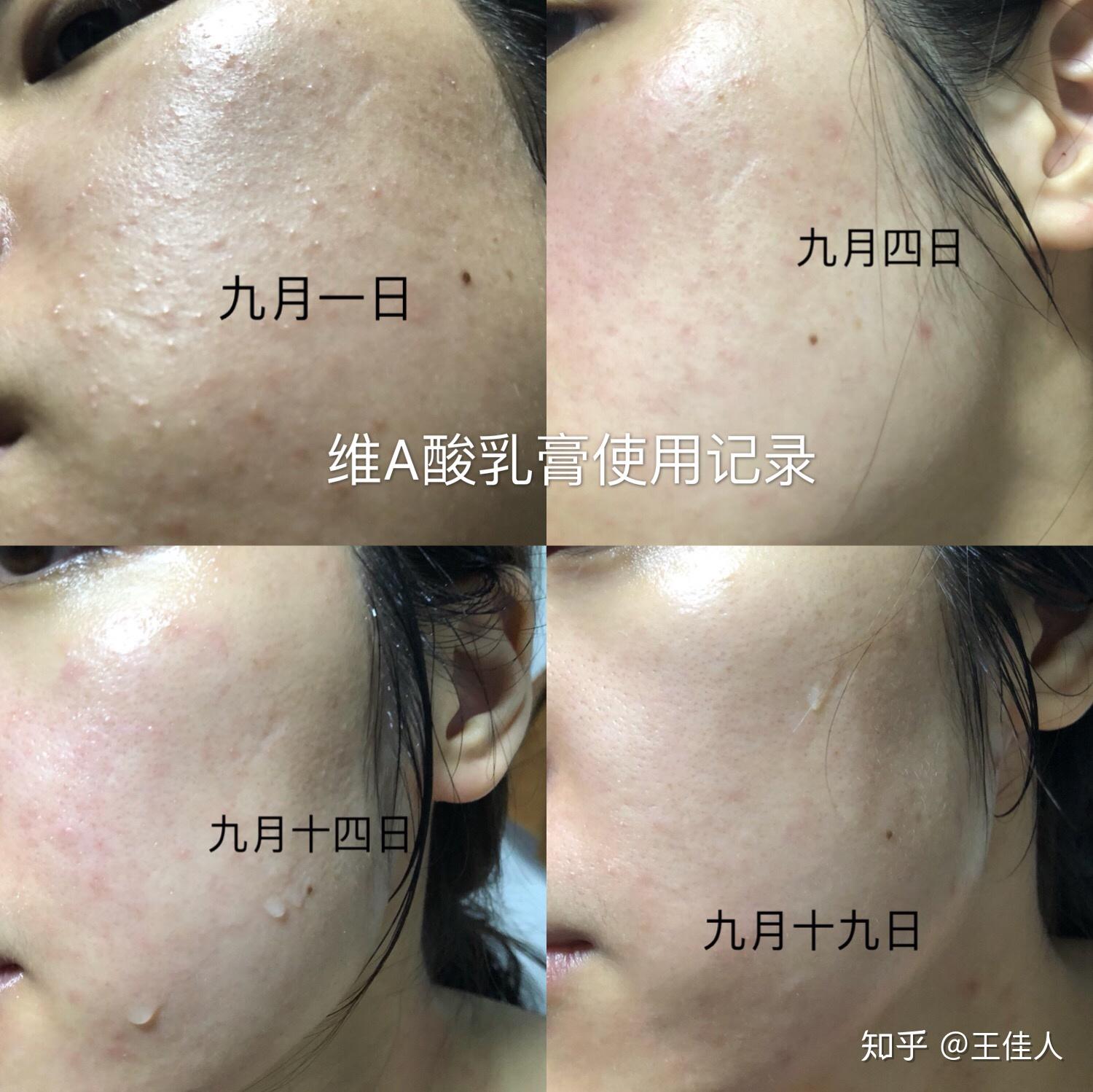 维a酸乳膏的使用记录