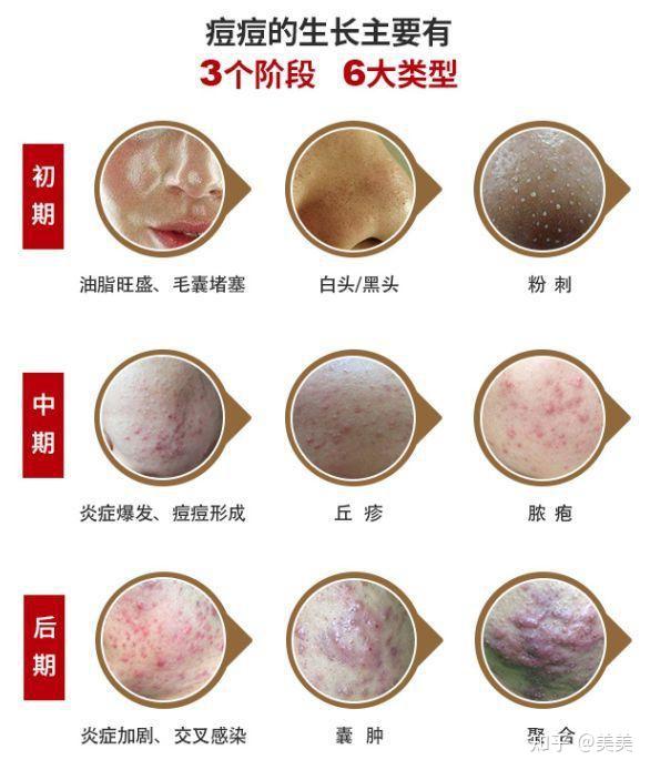 最有效的祛痘方法是什么? - 知乎