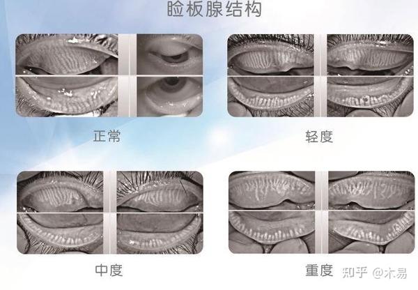睑板腺功能障碍 - 知乎