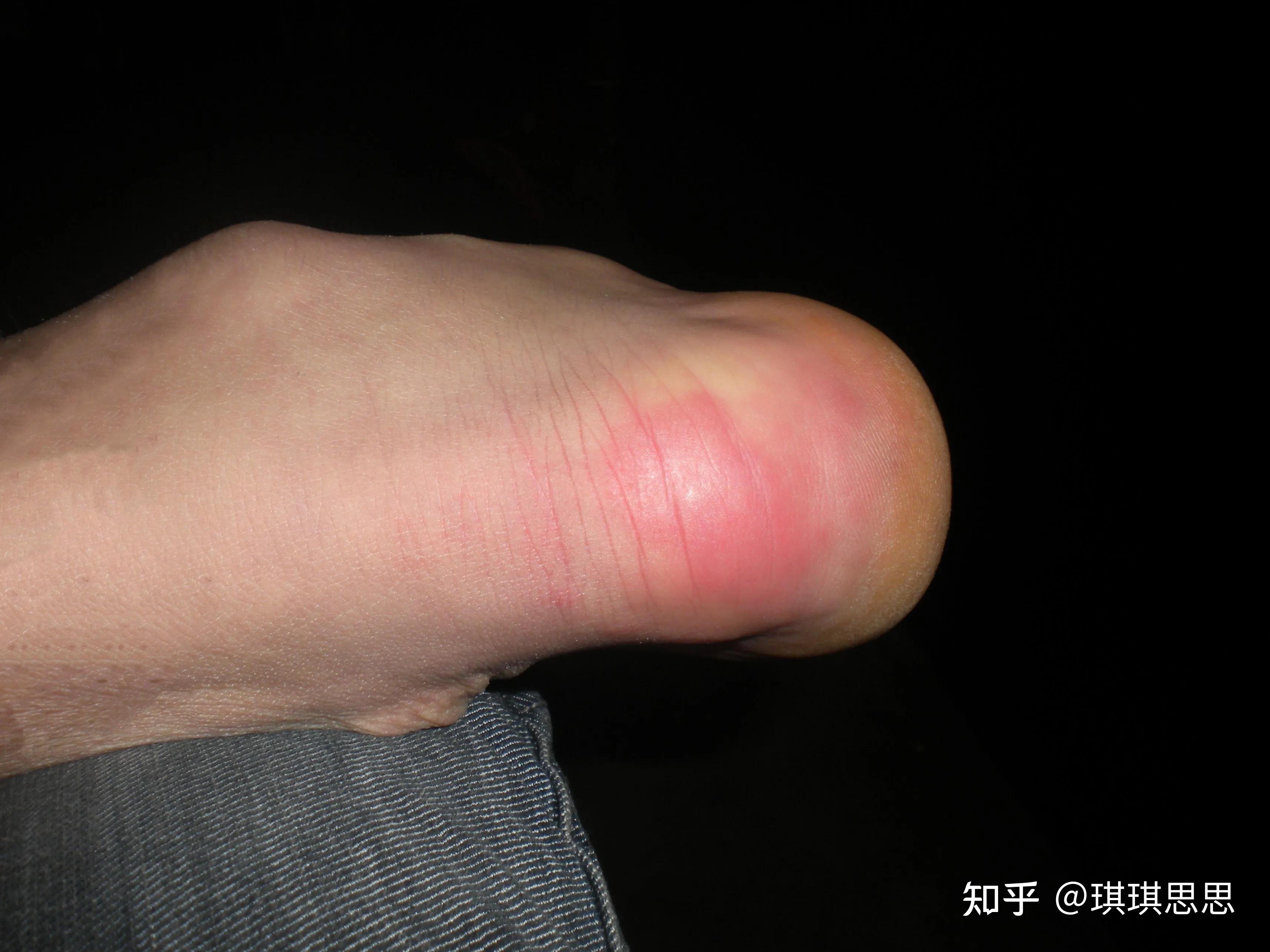 脚冻疮痒是什么表现?