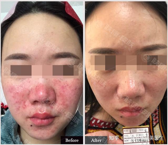 皮肤瘙痒起疙瘩，越抓越多，怎么办是好? - 知乎