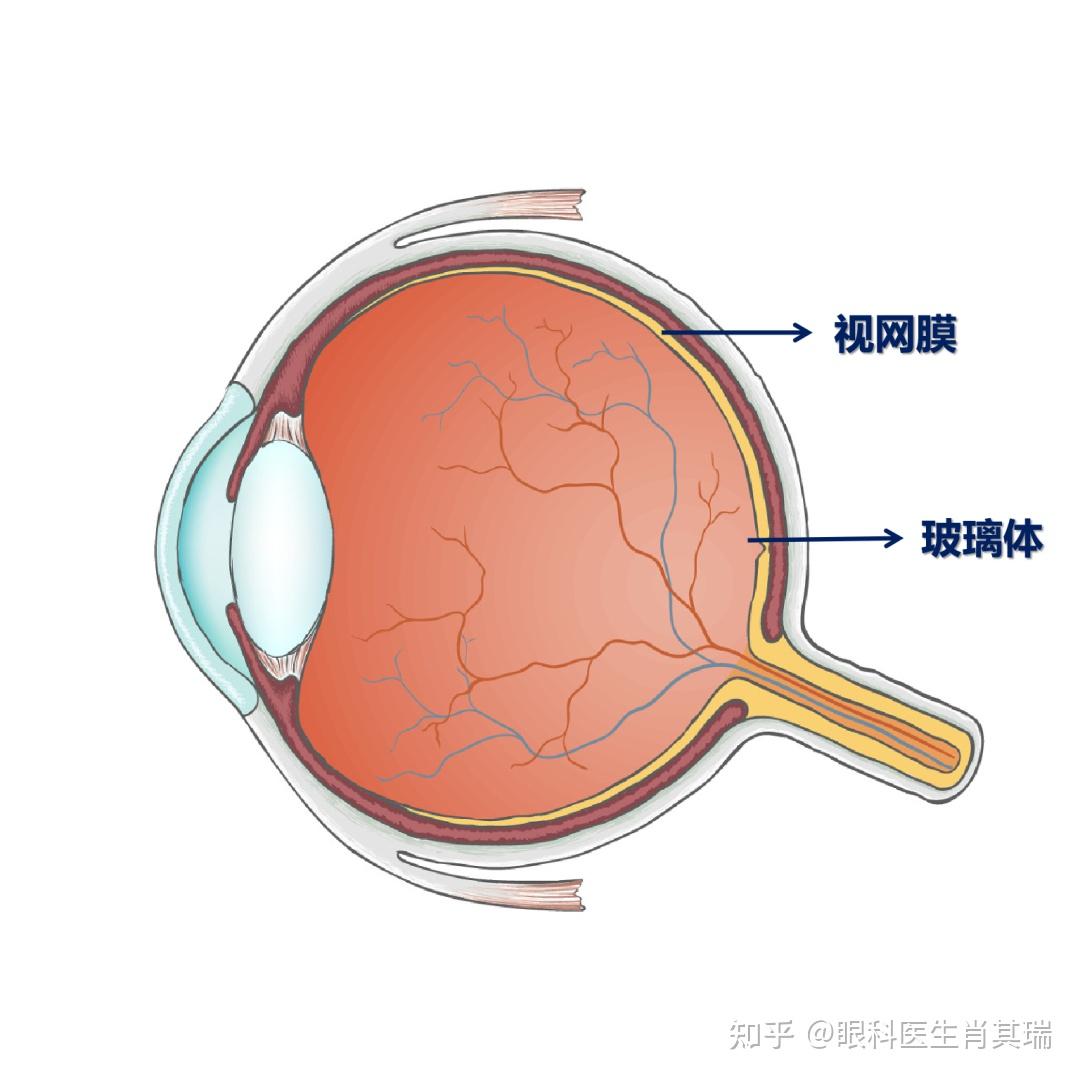 當水順著小孔慢慢流向外層並將視網膜頂開浮起與眼球壁發生分離也