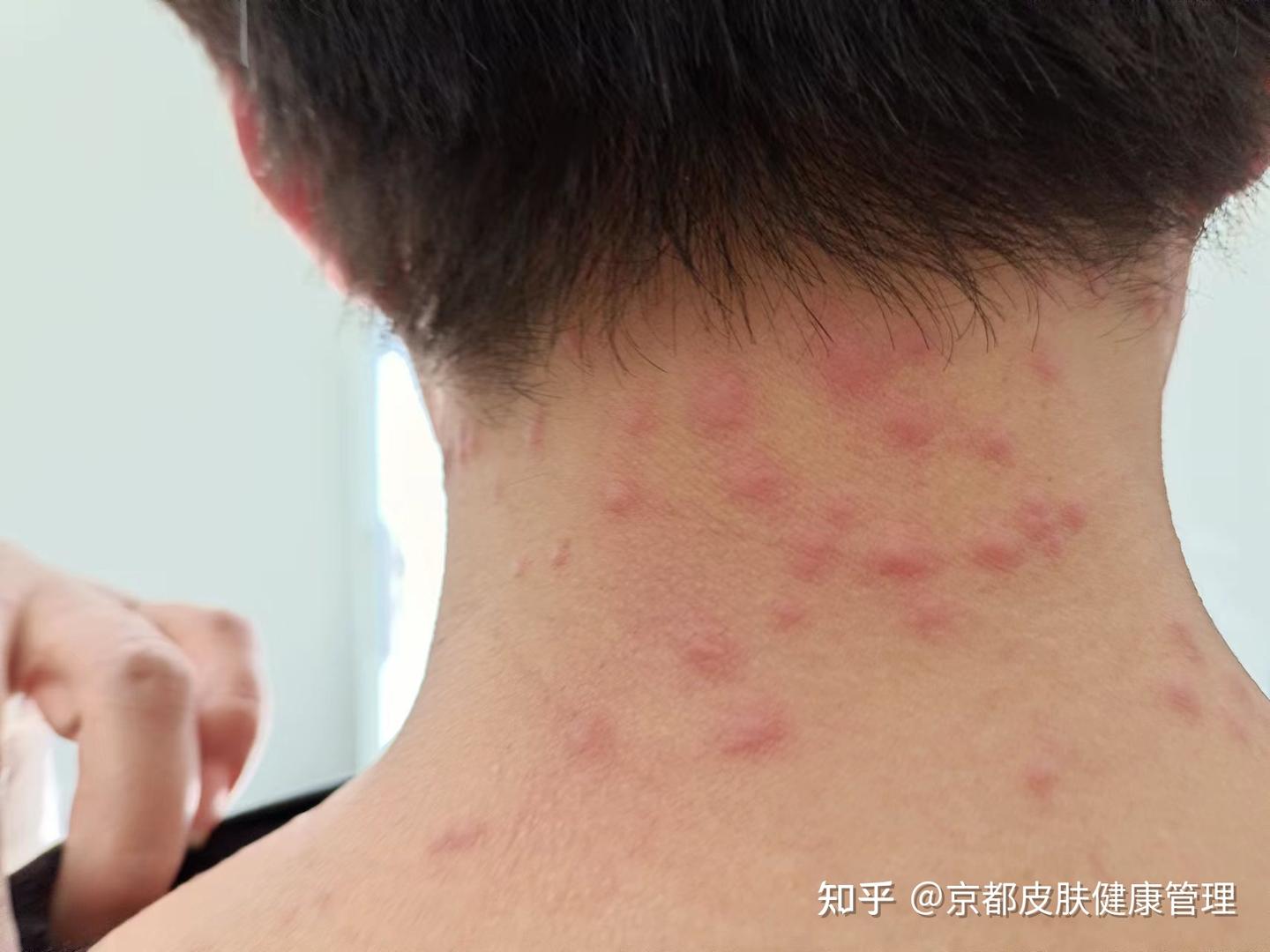 毛囊炎能治疗好吗? - 知乎