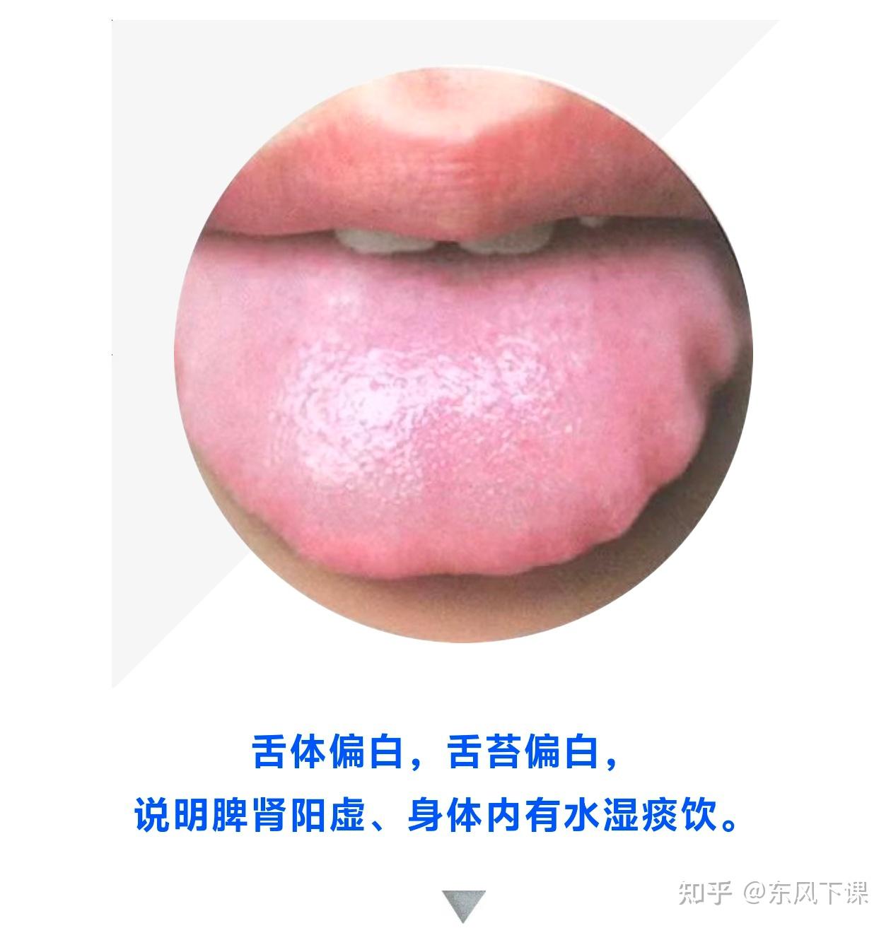 脾胃虚寒的腹胀是什么样?有图片吗? - 知乎