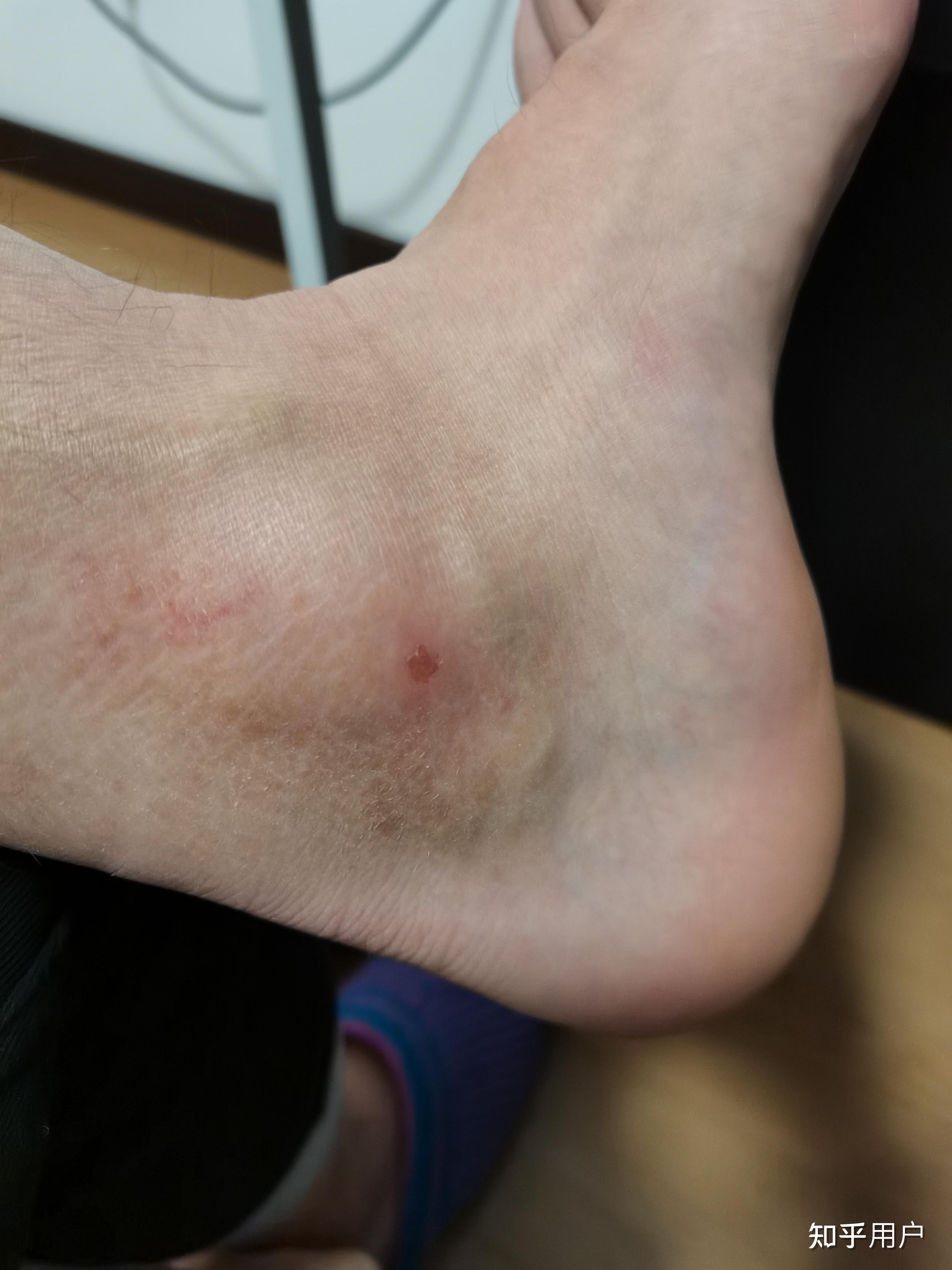 新鞋磨脚踝,刚穿两天,穿着高袜磨出血,鞋子内测被磨烂. - 知乎