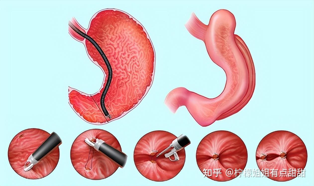 代謝手術是什麼意思肥胖切胃手術多少錢誰能解答