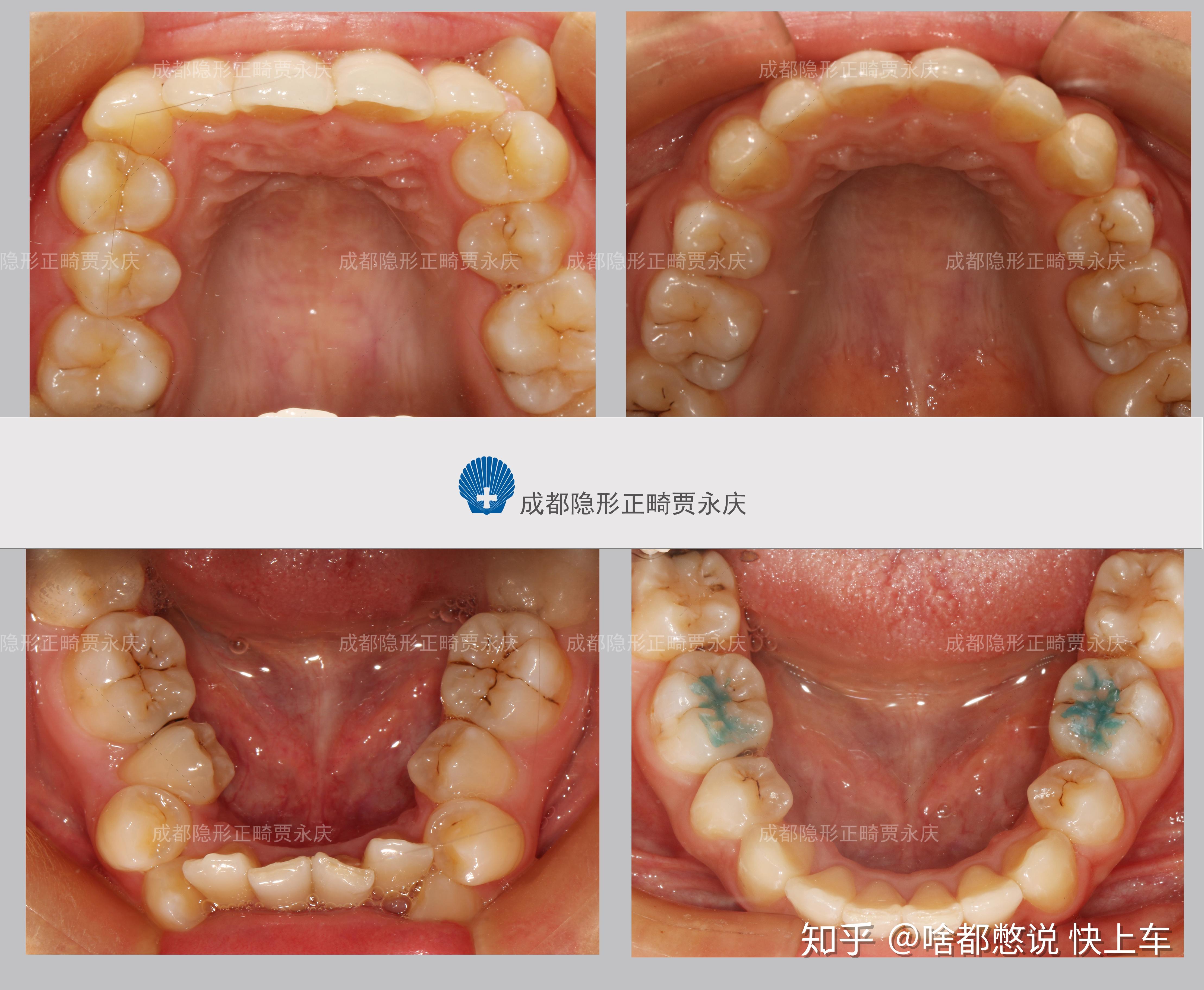 深覆合的危害,你真的了解吗?