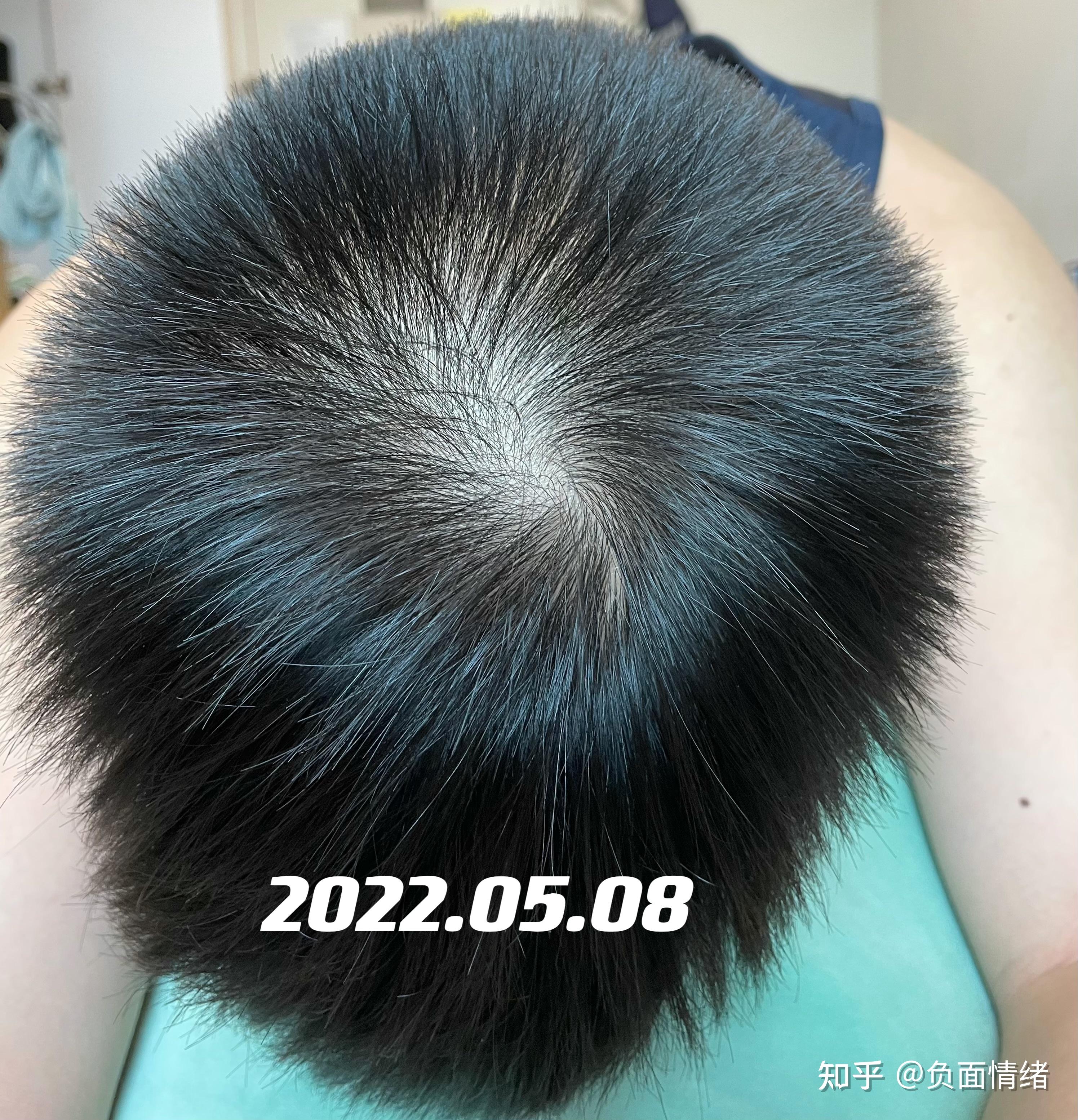 米诺地尔使用记录