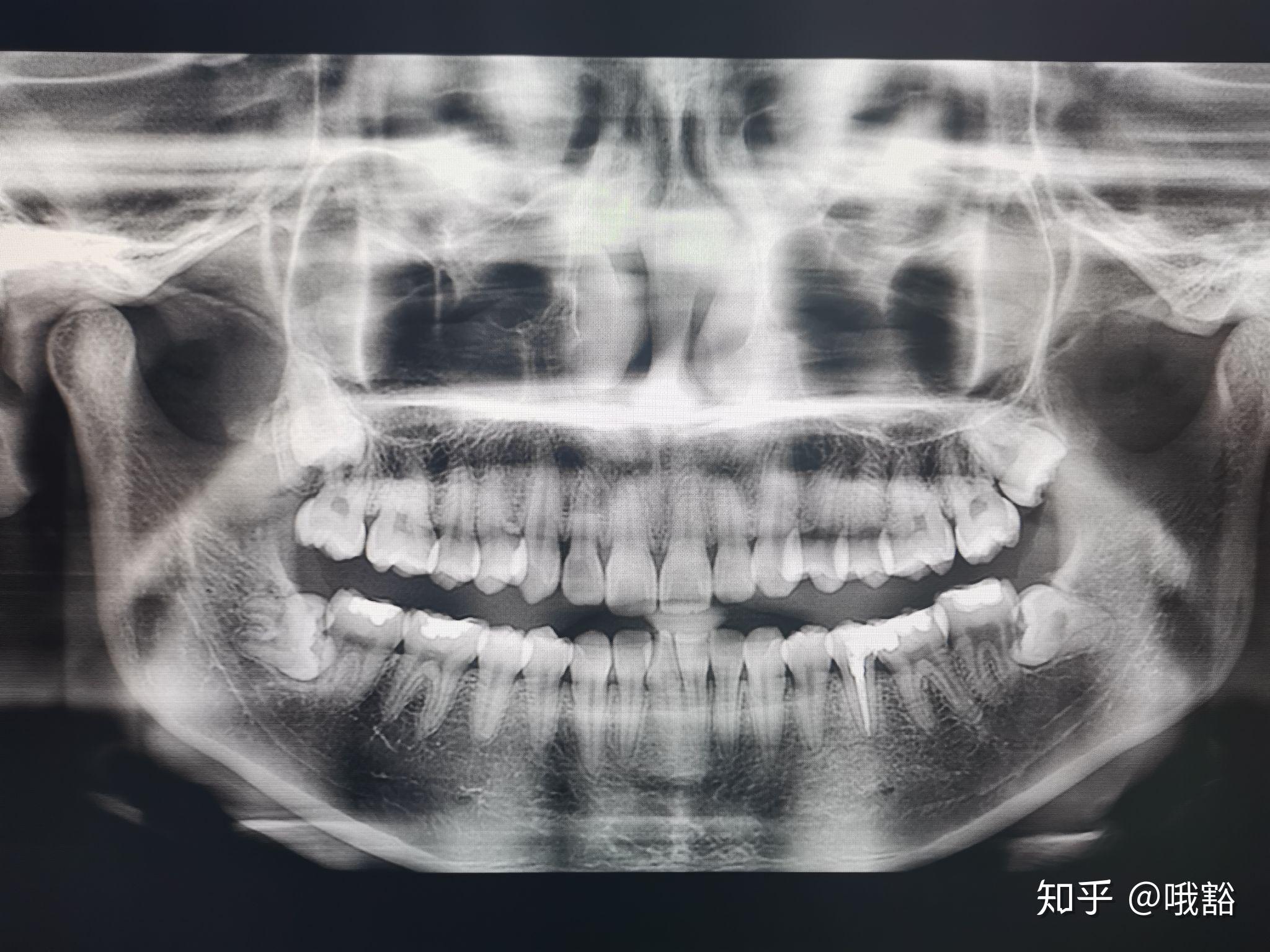 水平阻生齿拔除日记一