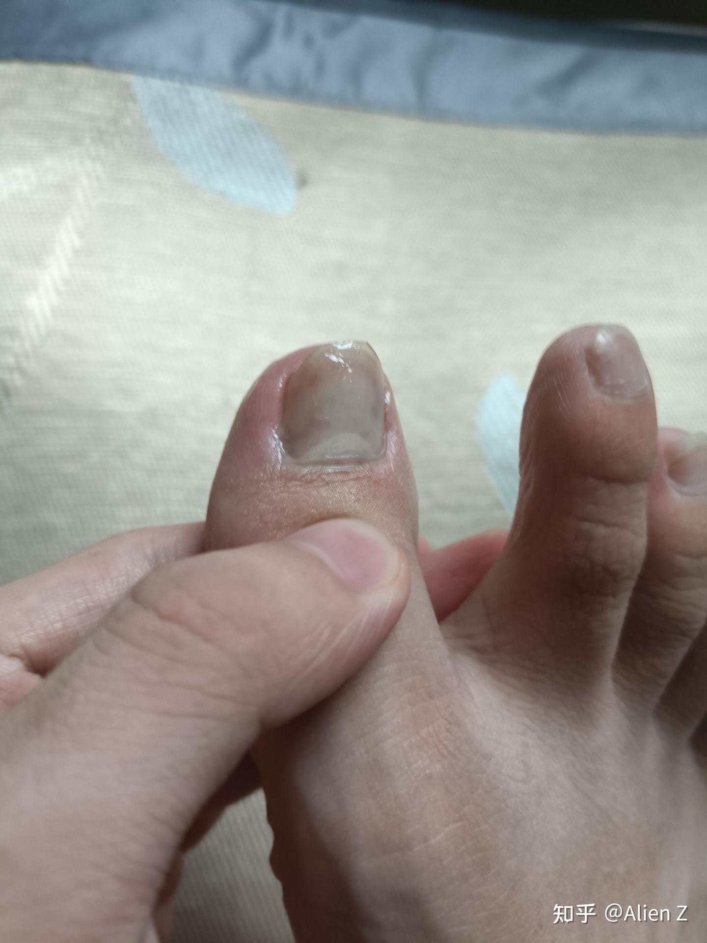 脚指头压伤恢复过程 - 知乎