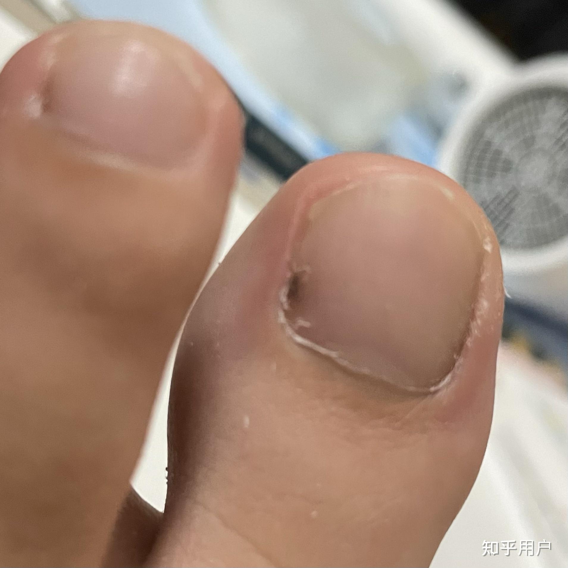 突然发现脚趾甲有个黑色的线型黑色的东西,左右大脚趾都有,请问是什么
