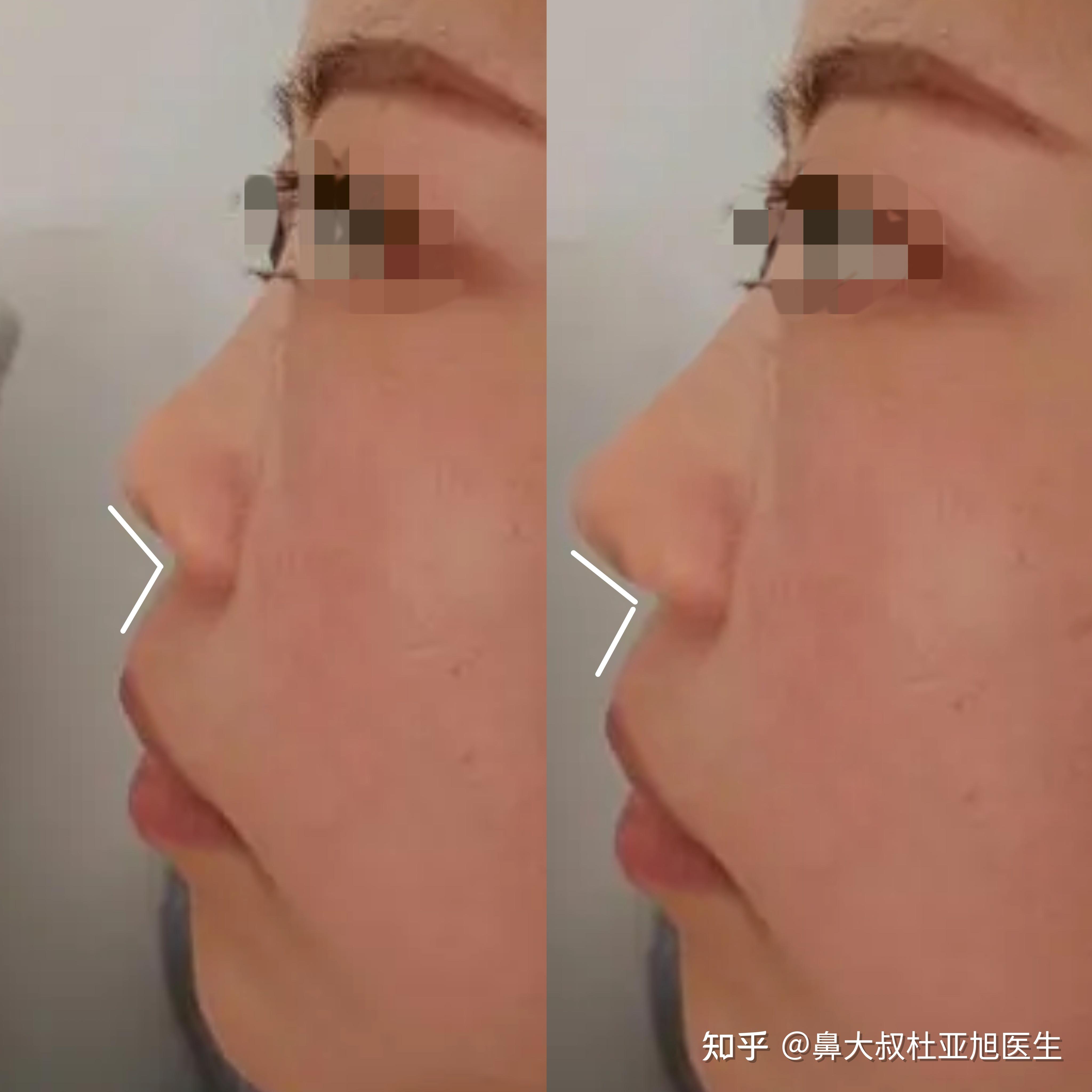 什么是朝天鼻?可纠正吗? - 知乎