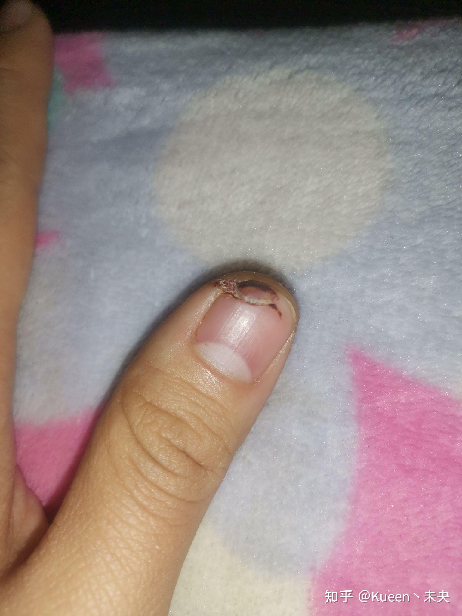指甲从中间断了 怎么快速愈合? - 知乎