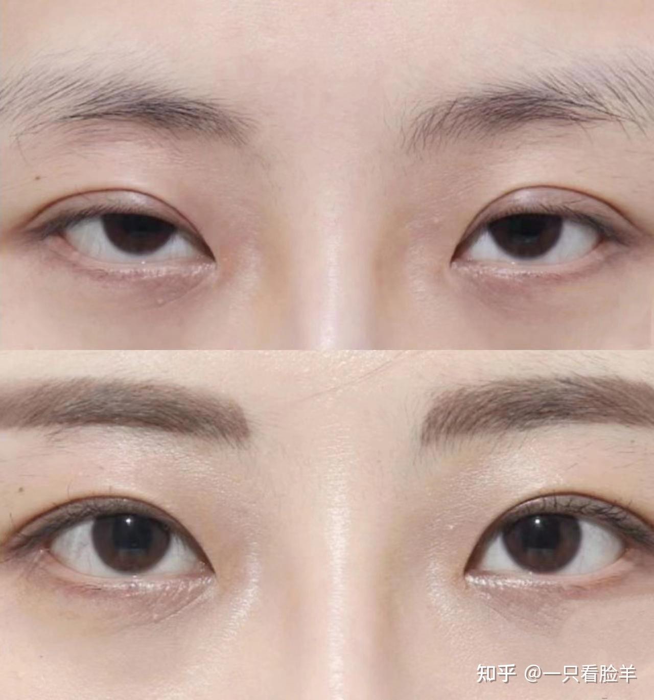 广州做双眼皮修复哪个医生比较好?