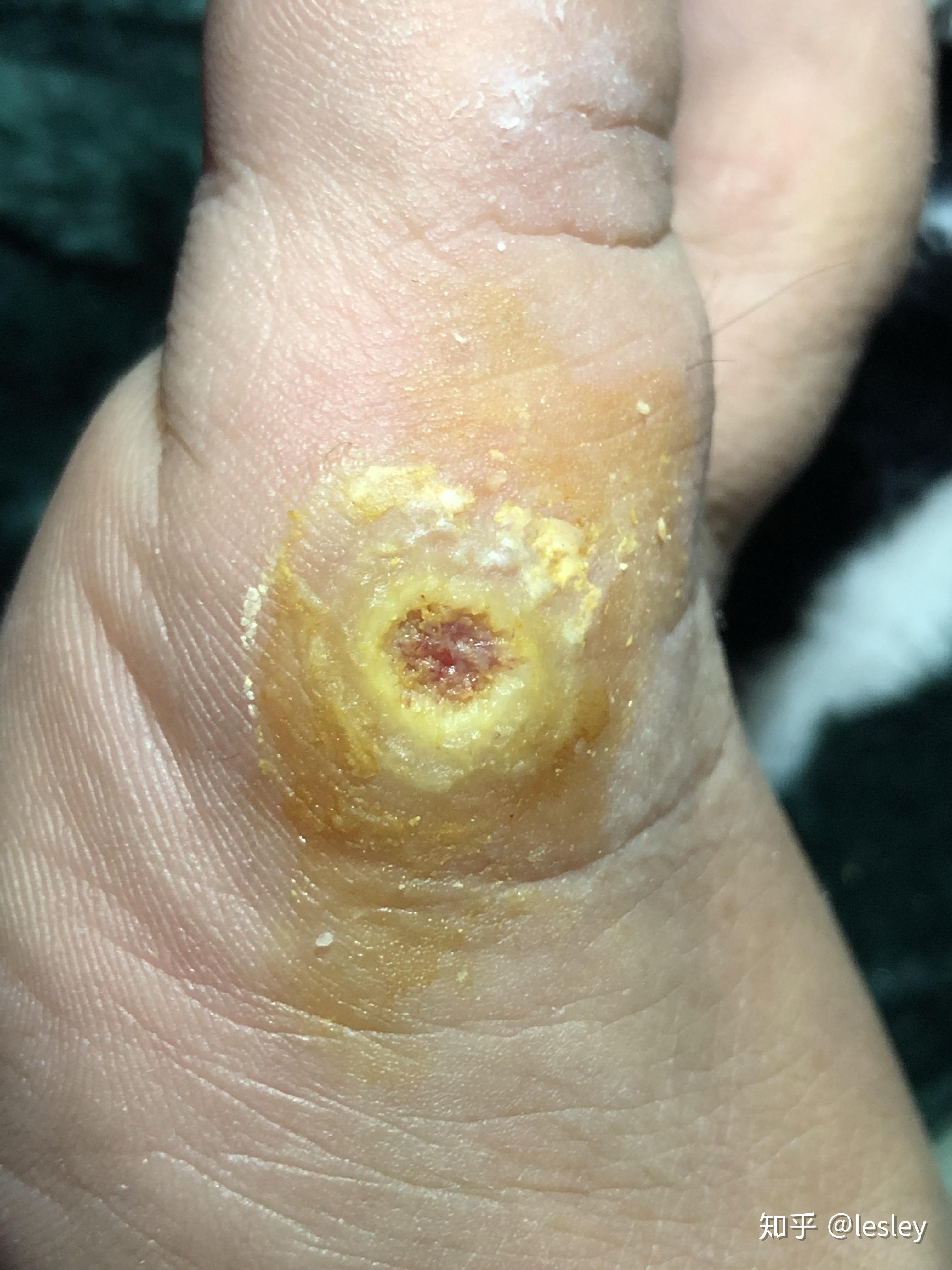 脚上长了跖疣怎么办