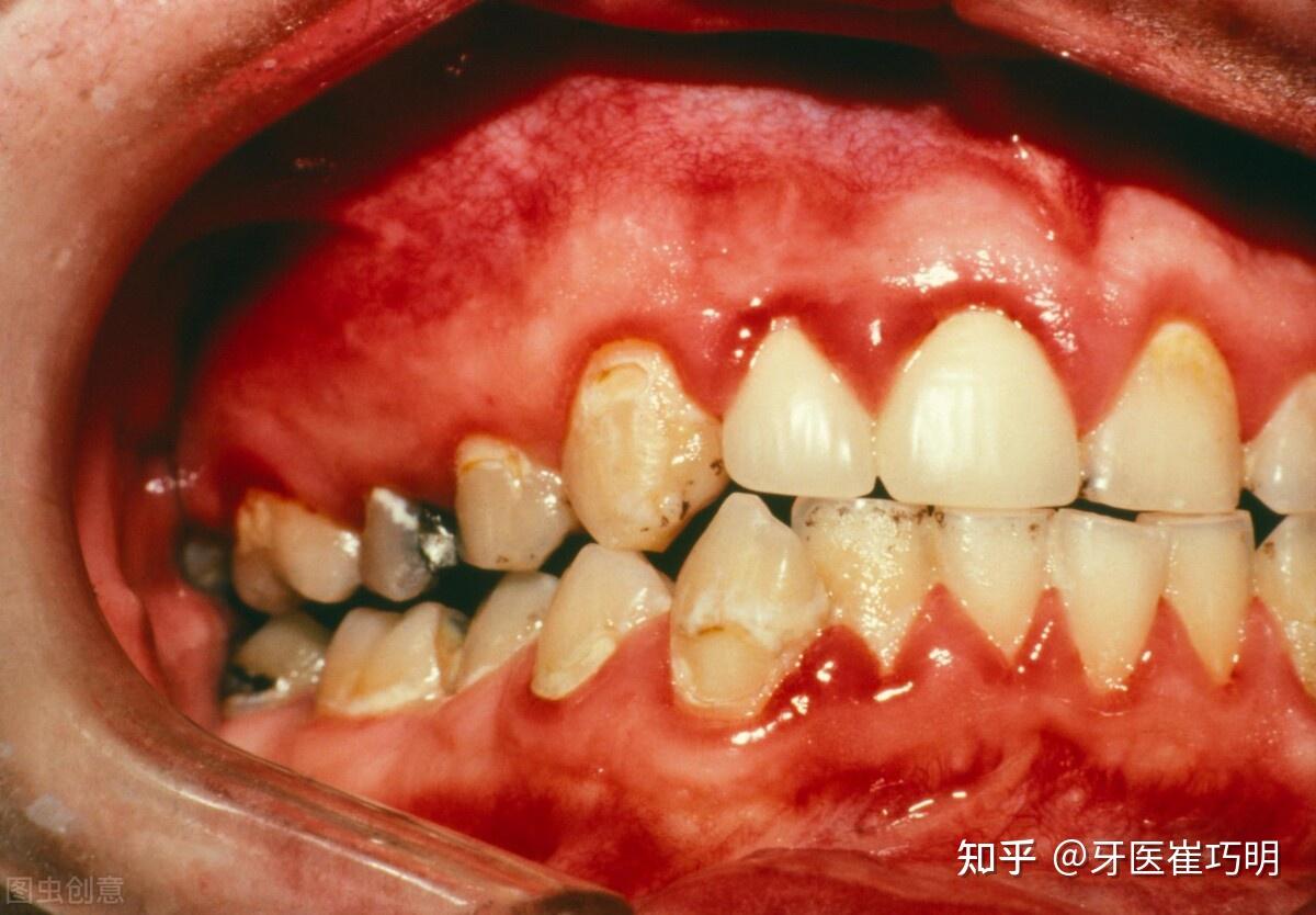 出现这几个症状必须重视否则牙齿要掉光