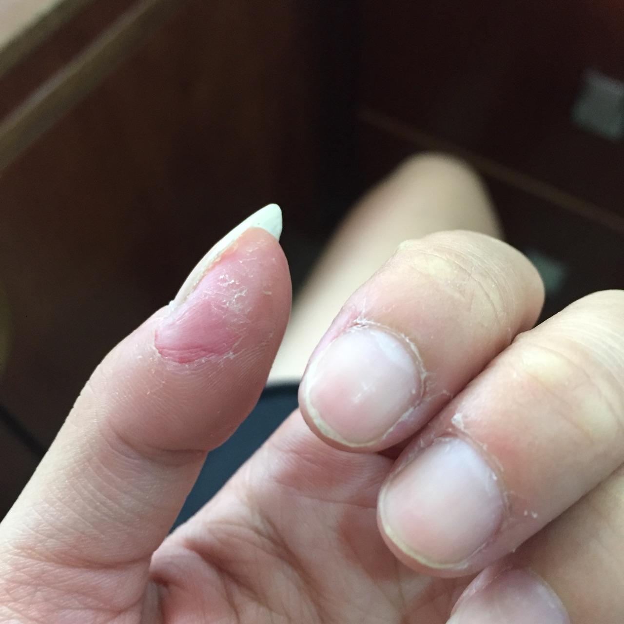 克制不住的抠手指头是心理问题吗?