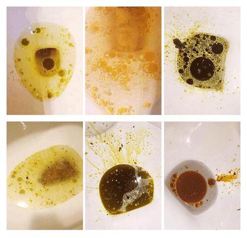 想问下吃过奥利司他减肥药的伙伴们有没有长过油性斑点? - 知乎