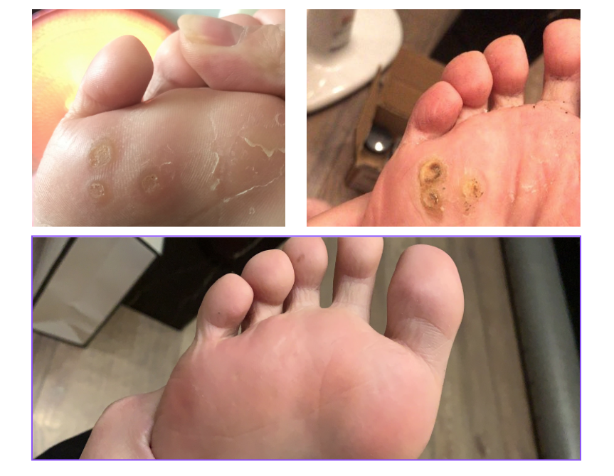 跖疣就是hpv携带者吗?