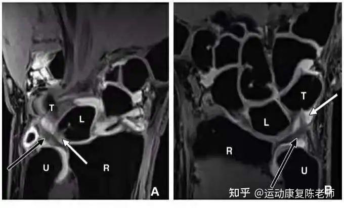 三角纤维软骨tfcc损伤该如何治疗和康复呢