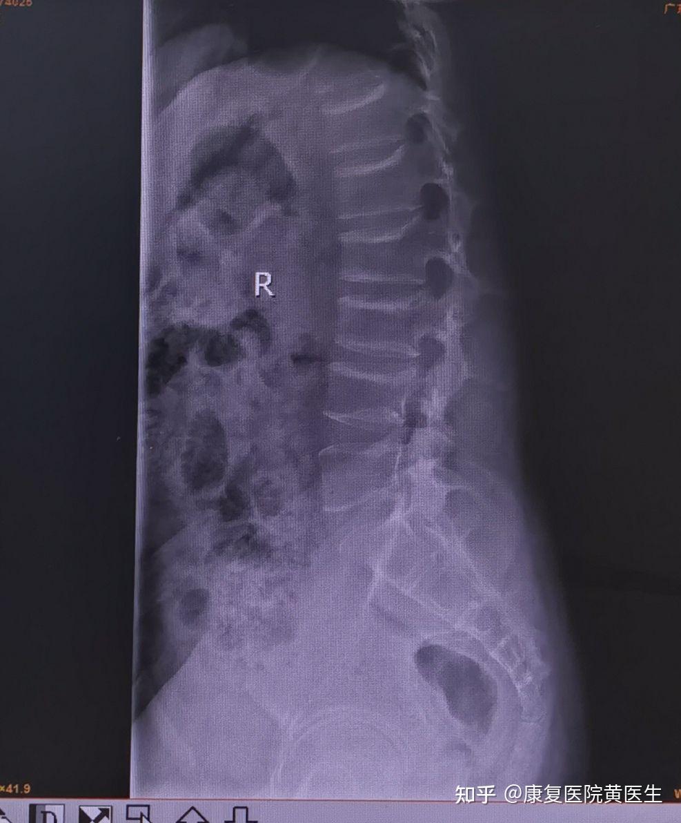 脊柱后凸畸形,休门氏病的治疗